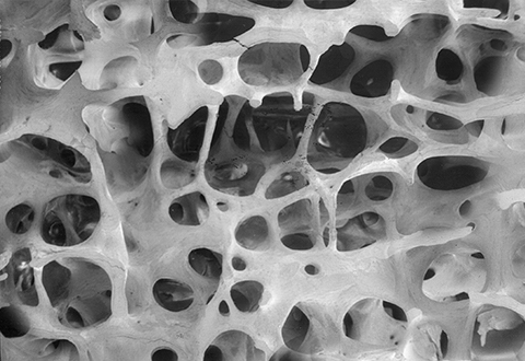 Interactive image of bone with a T-score of -2.5 or lower, which is defined as osteopenia.