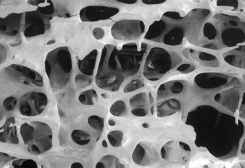 Interactive image of bone with a T-score of -2.5 or lower, which is defined as osteopenia.