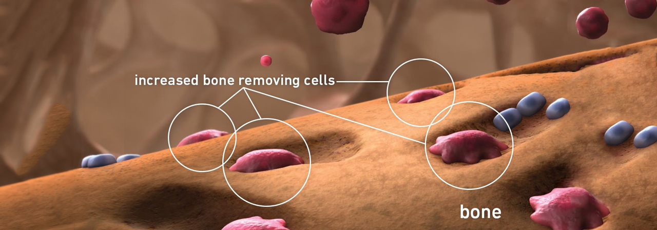 Interactive slider image showing bone-removing cells impacting your bone without treatment and with Prolia® (denosumab)