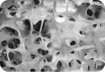 Progression of postmenopausal osteoporosis without treatment